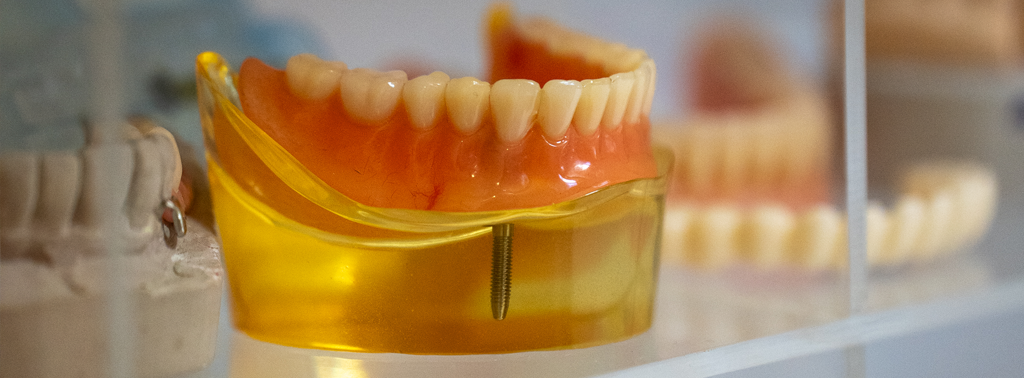 Diş Hekimi Engin Aksoy | Dental İmplantlar