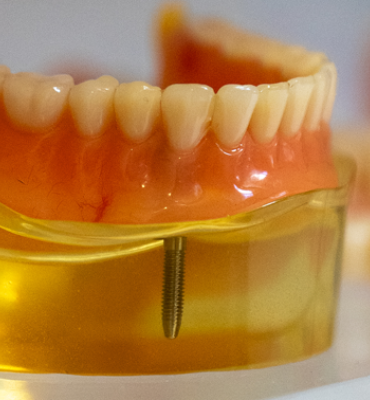 Diş Hekimi Engin Aksoy | Hizmetlerimiz - İmplantoloji & Cerrahi İşlemler - Dental İmplantlar