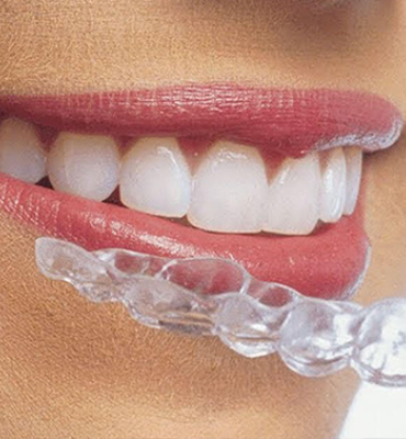 Diş Hekimi Engin Aksoy | Hizmetlerimiz - Diş Sıkma ve Eklem Bozuklukları - Gece Plağı (Michigan Splint) Tedavisi