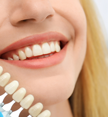 Diş Hekimi Engin Aksoy | Hizmetlerimiz - Protetik Diş Tedavileri - Porselen Laminalar (Veneers)
