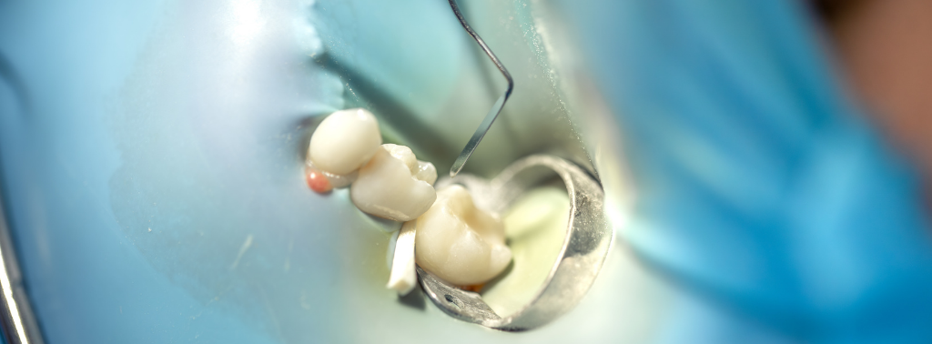 Diş Hekimi Engin Aksoy | Ceramic Fillings